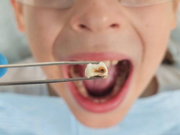 Best Emergency Tooth Extraction in Sunman, IN